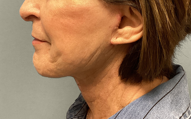 NECK LIFT Before & After Gallery - Patient 159366 - Image 3