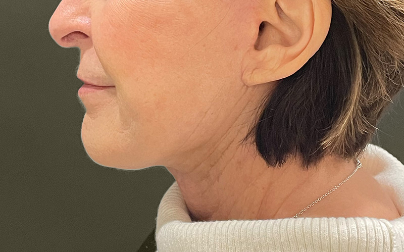 NECK LIFT Before & After Gallery - Patient 159366 - Image 4
