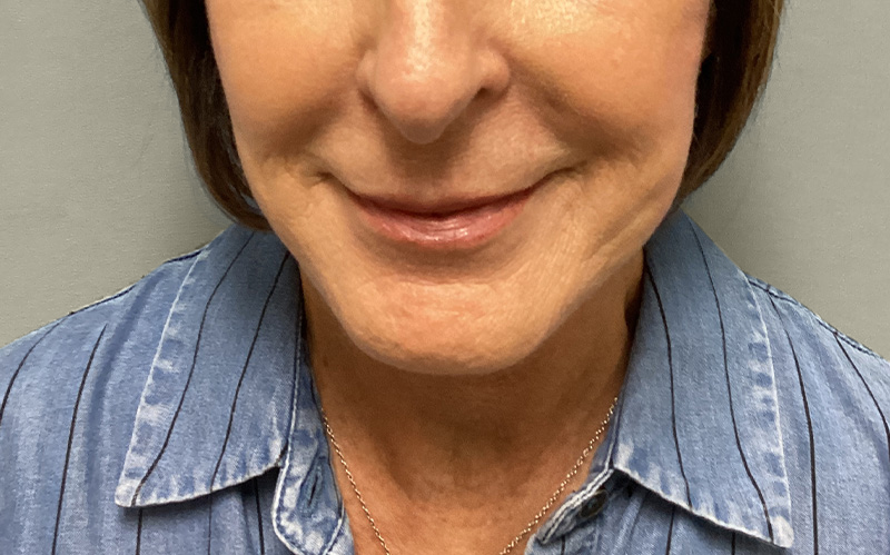 NECK LIFT Before & After Gallery - Patient 159366 - Image 5