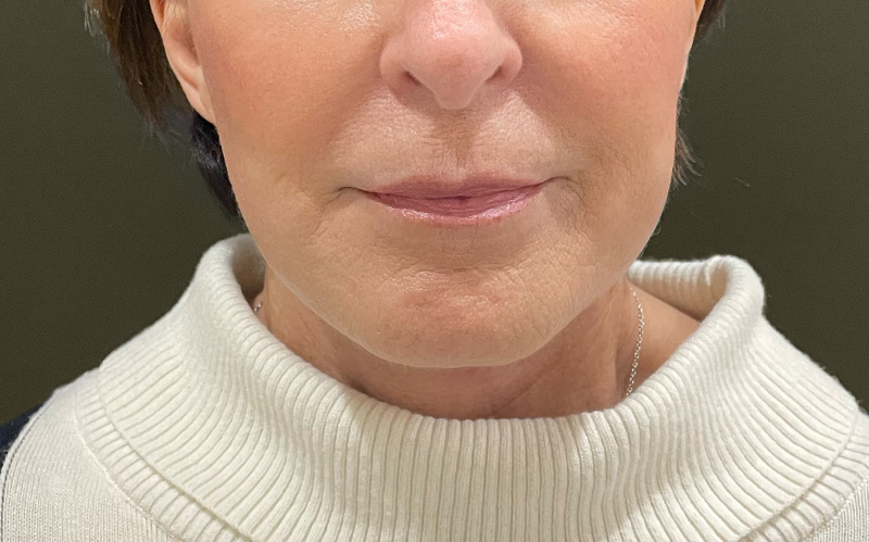 NECK LIFT Before & After Gallery - Patient 159366 - Image 6