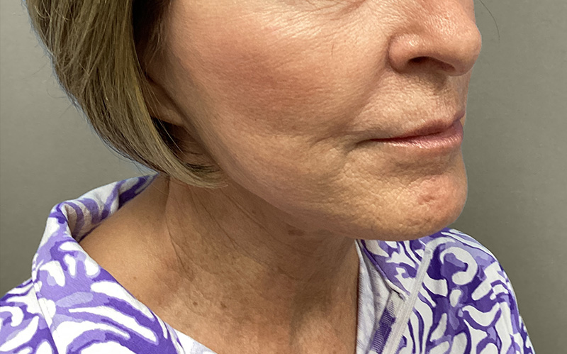 NECK LIFT Before & After Gallery - Patient 159366 - Image 7