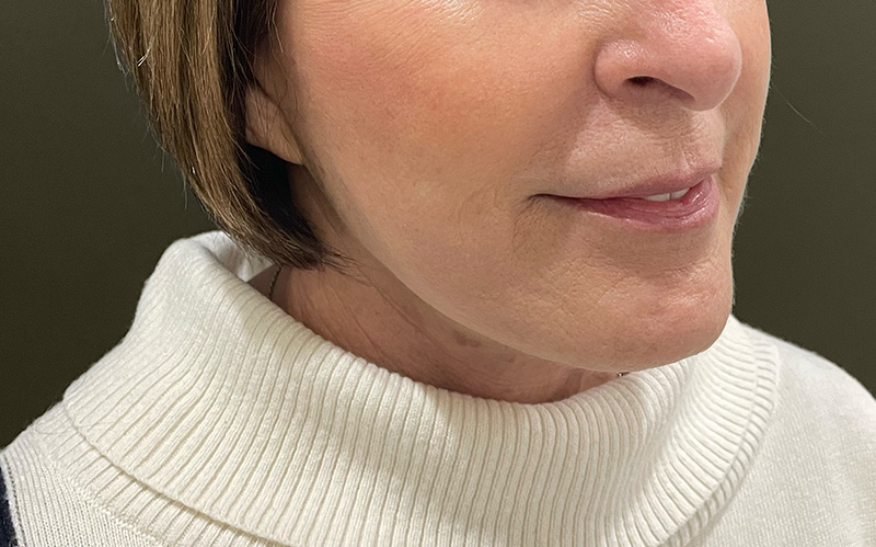 NECK LIFT Before & After Gallery - Patient 159366 - Image 8