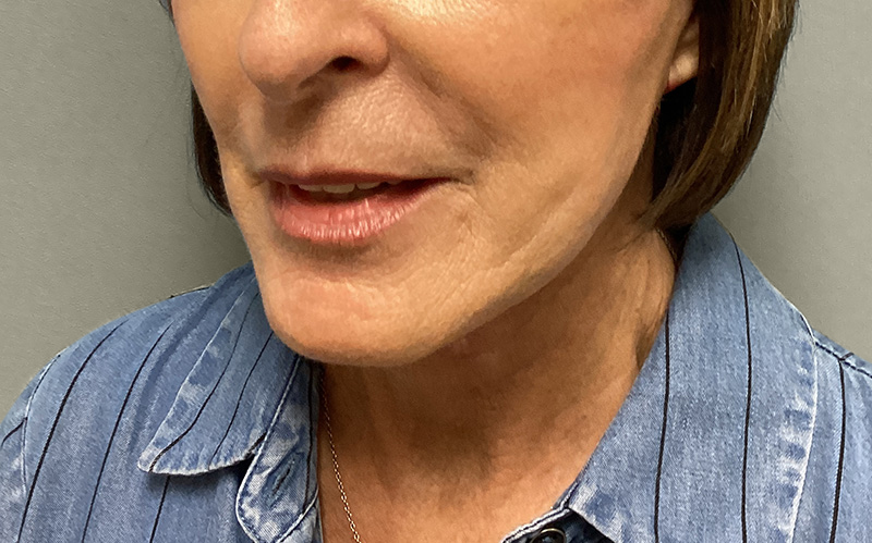NECK LIFT Before & After Gallery - Patient 159366 - Image 9