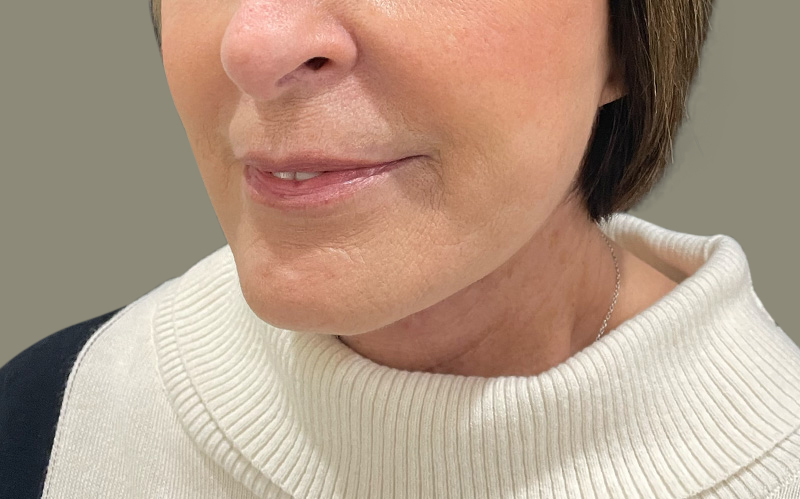 NECK LIFT Before & After Gallery - Patient 159366 - Image 10