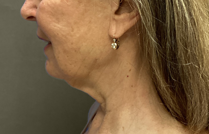 NECK LIFT Before & After Gallery - Patient 188757 - Image 1