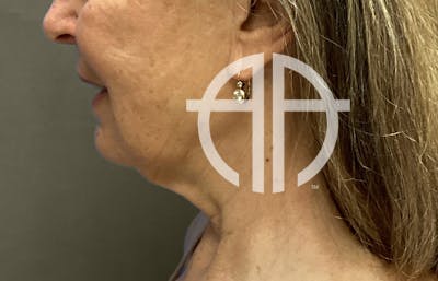 NECK LIFT Before & After Gallery - Patient 188757 - Image 1