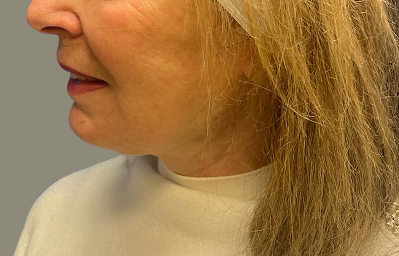 NECK LIFT Before & After Gallery - Patient 188757 - Image 2