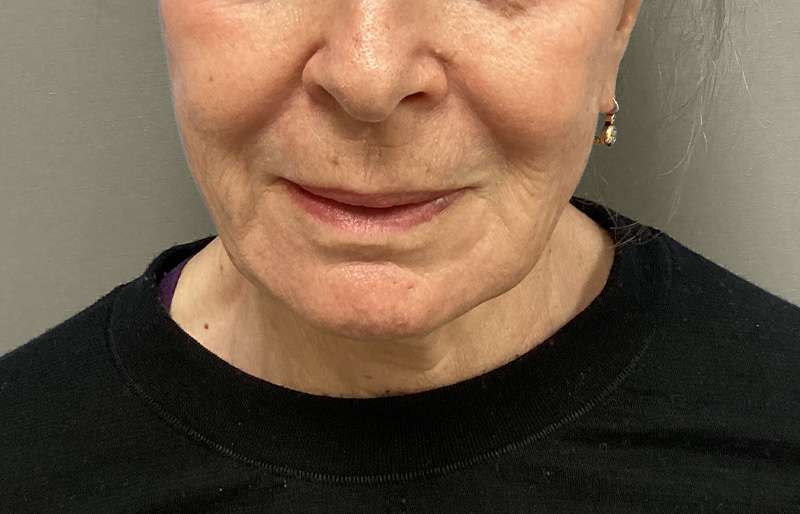 NECK LIFT Before & After Gallery - Patient 188757 - Image 3