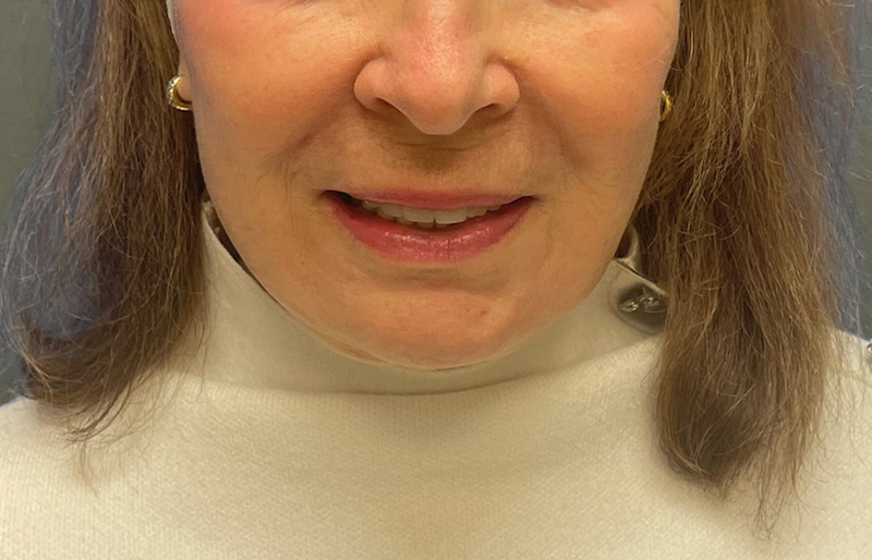 NECK LIFT Before & After Gallery - Patient 188757 - Image 4