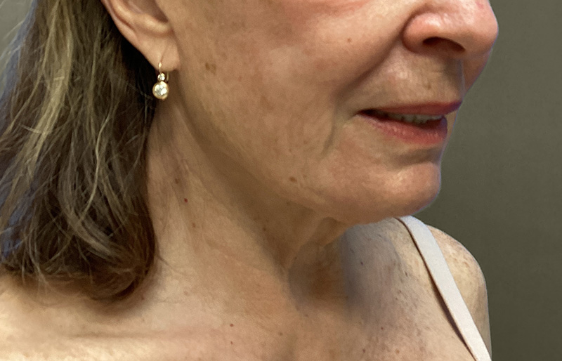 NECK LIFT Before & After Gallery - Patient 188757 - Image 5