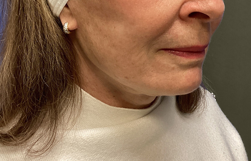 NECK LIFT Before & After Gallery - Patient 188757 - Image 6