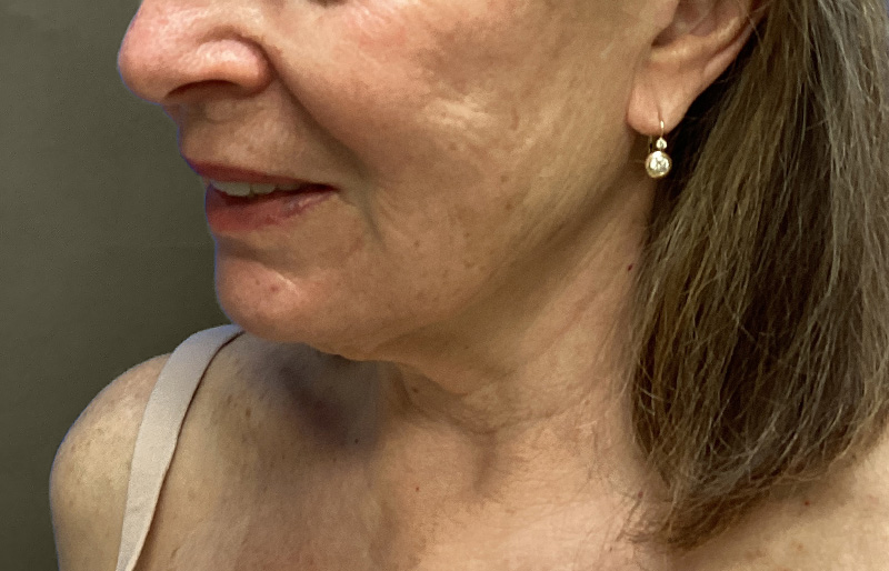 NECK LIFT Before & After Gallery - Patient 188757 - Image 8