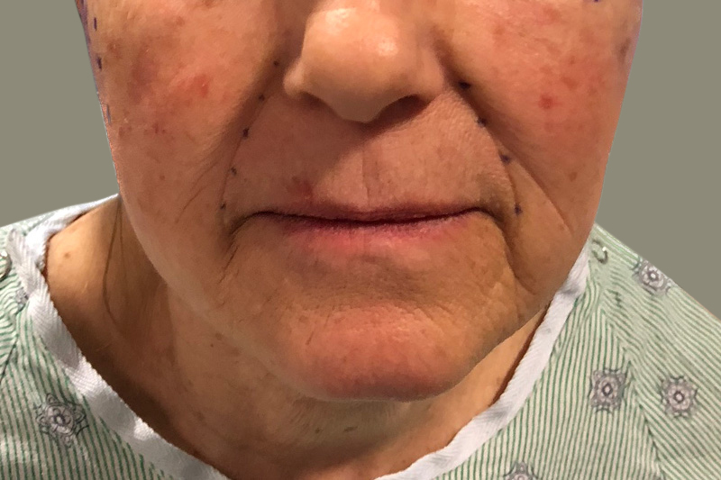 NECK LIFT Before & After Gallery - Patient 215574 - Image 1