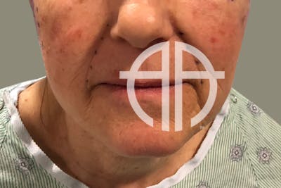 NECK LIFT Before & After Gallery - Patient 215574 - Image 1