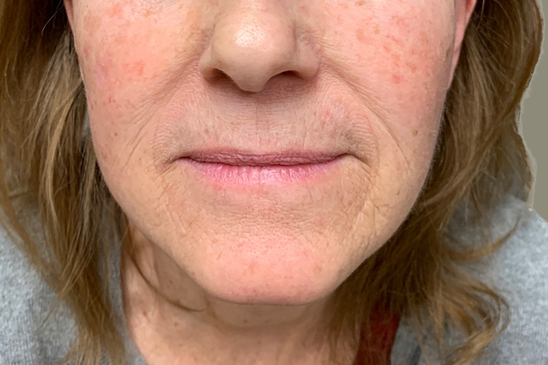 NECK LIFT Before & After Gallery - Patient 215574 - Image 2