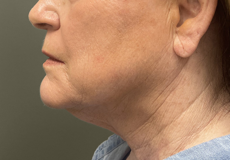 NECK LIFT Before & After Gallery - Patient 245199 - Image 1