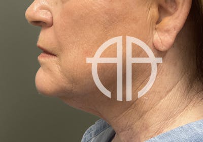 NECK LIFT Before & After Gallery - Patient 245199 - Image 1