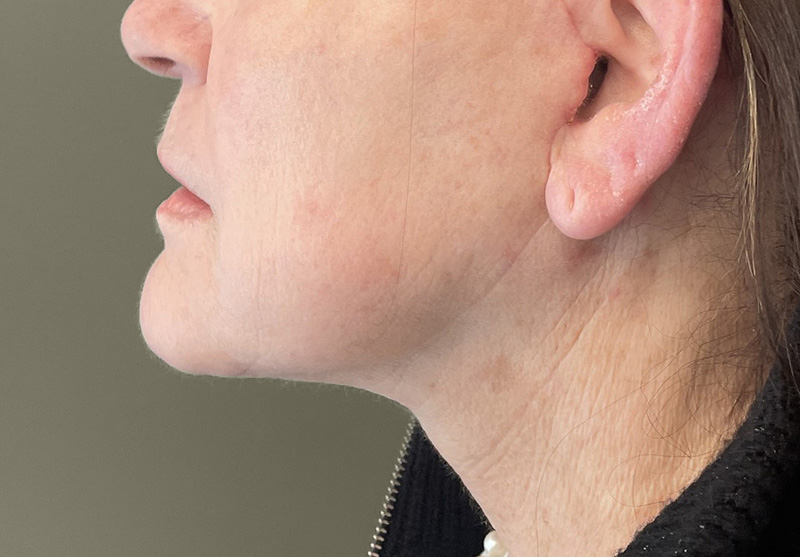 NECK LIFT Before & After Gallery - Patient 245199 - Image 2