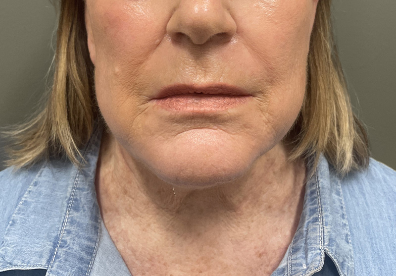 NECK LIFT Before & After Gallery - Patient 245199 - Image 3
