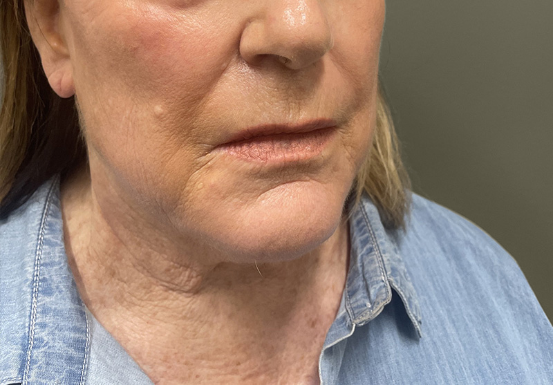 NECK LIFT Before & After Gallery - Patient 245199 - Image 5
