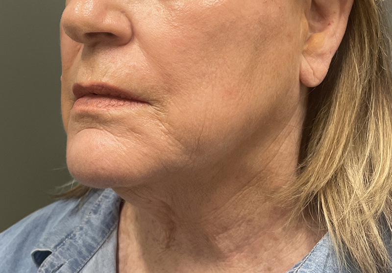 NECK LIFT Before & After Gallery - Patient 245199 - Image 7
