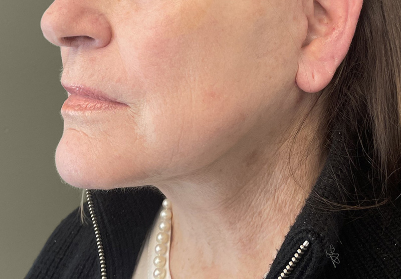 NECK LIFT Before & After Gallery - Patient 245199 - Image 8