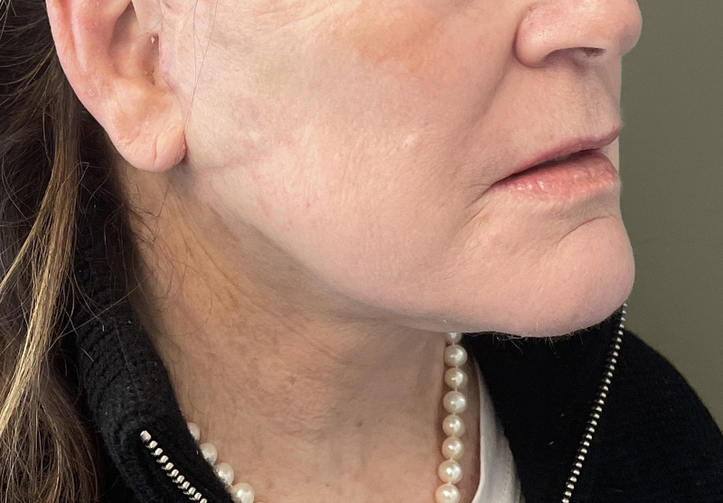 NECK LIFT Before & After Gallery - Patient 245199 - Image 6