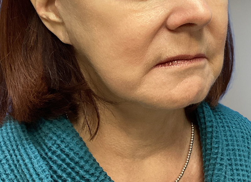 NECK LIFT Before & After Gallery - Patient 261403 - Image 4