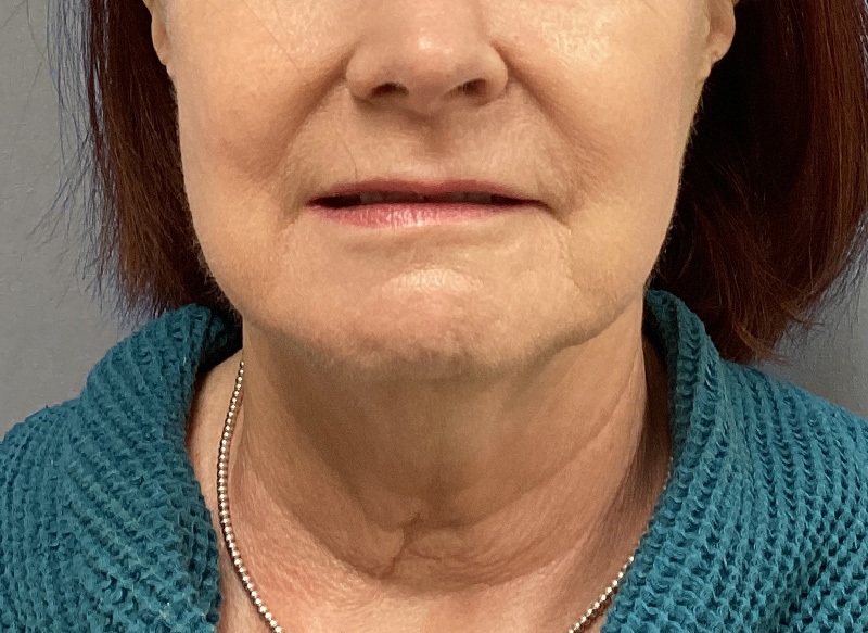 NECK LIFT Before & After Gallery - Patient 261403 - Image 5