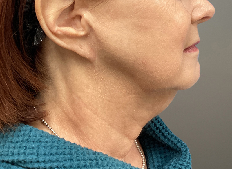 NECK LIFT Before & After Gallery - Patient 261403 - Image 1