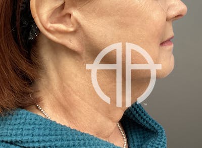 NECK LIFT Before & After Gallery - Patient 261403 - Image 1