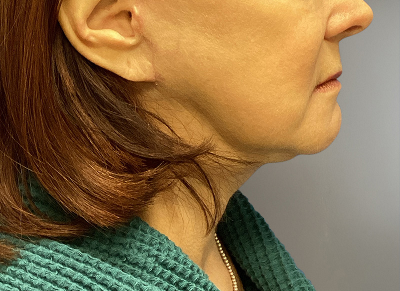 NECK LIFT Before & After Gallery - Patient 261403 - Image 2
