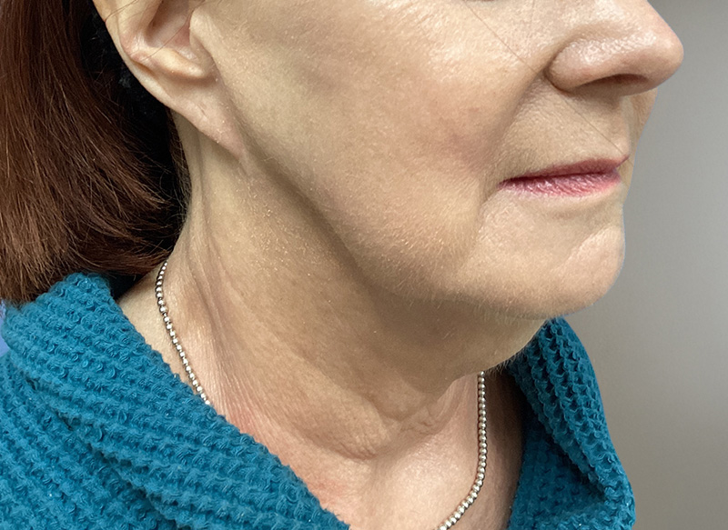NECK LIFT Before & After Gallery - Patient 261403 - Image 3