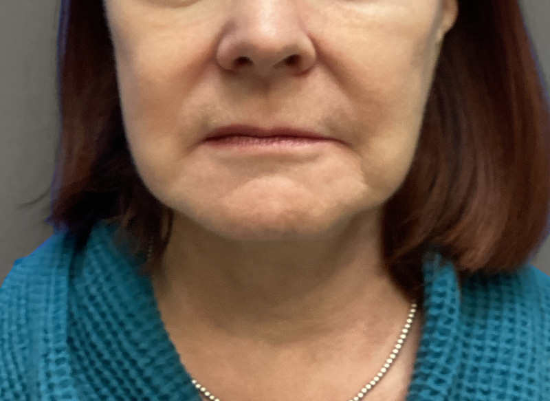 NECK LIFT Before & After Gallery - Patient 261403 - Image 6