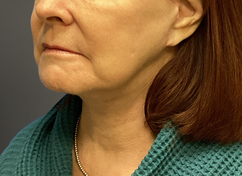 NECK LIFT Before & After Gallery - Patient 261403 - Image 8