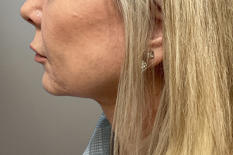 NECK LIFT Before & After Gallery - Patient 266386 - Image 1