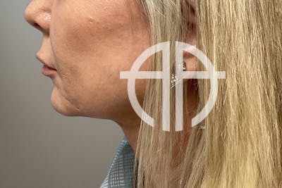 NECK LIFT Before & After Gallery - Patient 266386 - Image 1