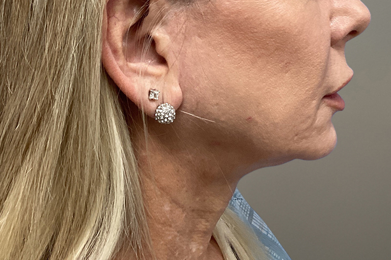 NECK LIFT Before & After Gallery - Patient 266386 - Image 3