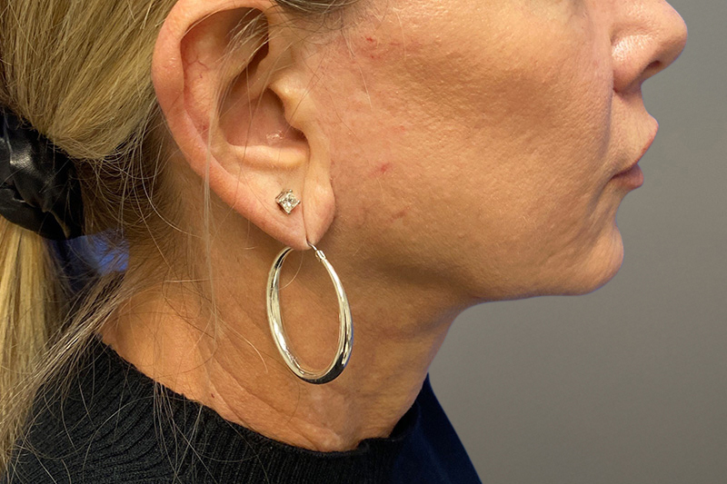 NECK LIFT Before & After Gallery - Patient 266386 - Image 4