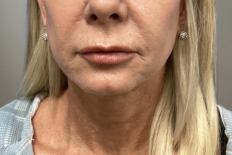 NECK LIFT Before & After Gallery - Patient 266386 - Image 5