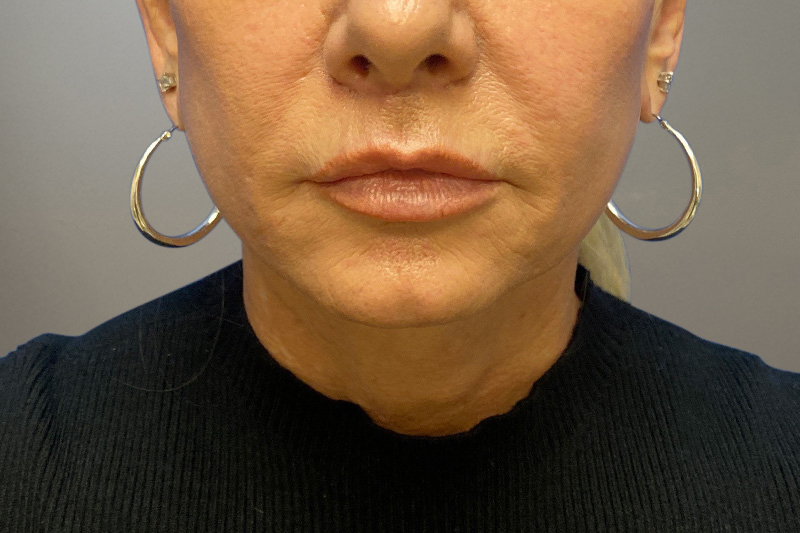 NECK LIFT Before & After Gallery - Patient 266386 - Image 6