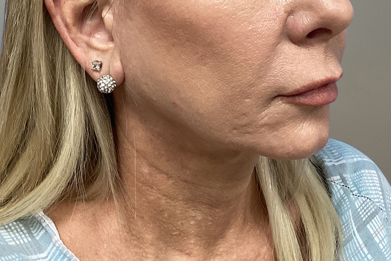 NECK LIFT Before & After Gallery - Patient 266386 - Image 7