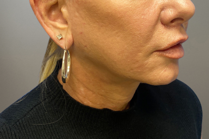 NECK LIFT Before & After Gallery - Patient 266386 - Image 8
