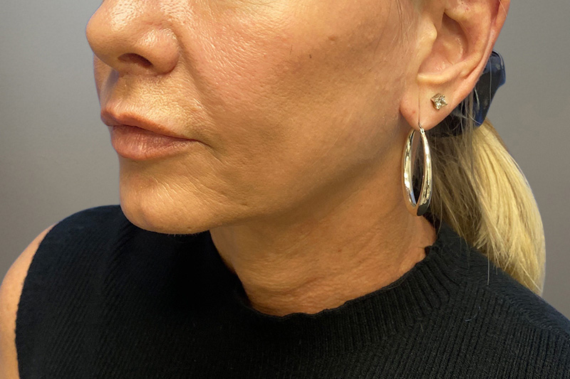 NECK LIFT Before & After Gallery - Patient 266386 - Image 10
