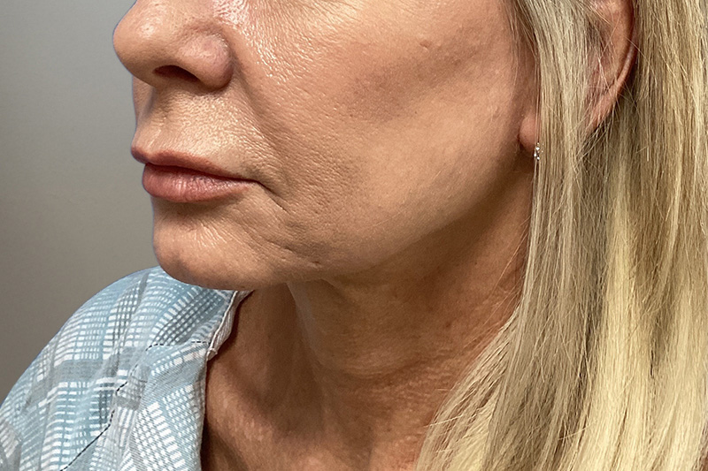NECK LIFT Before & After Gallery - Patient 266386 - Image 9