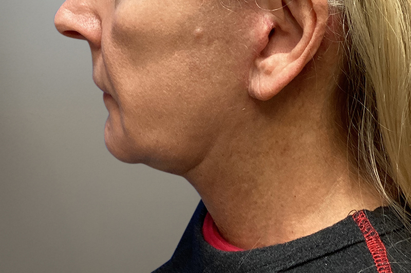NECK LIFT Before & After Gallery - Patient 387399 - Image 1