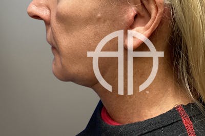 NECK LIFT Before & After Gallery - Patient 387399 - Image 1