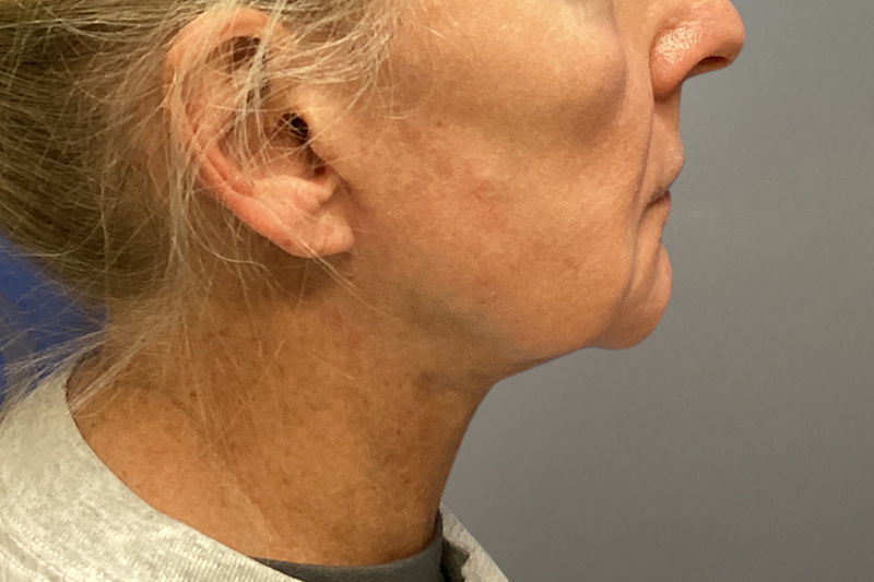 NECK LIFT Before & After Gallery - Patient 387399 - Image 4