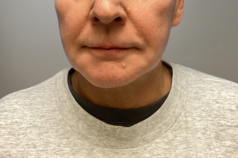 NECK LIFT Before & After Gallery - Patient 387399 - Image 6