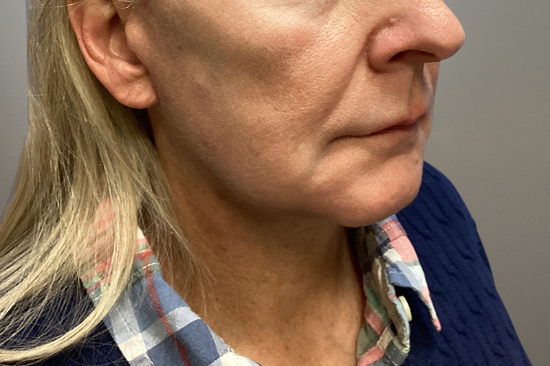 NECK LIFT Before & After Gallery - Patient 387399 - Image 7